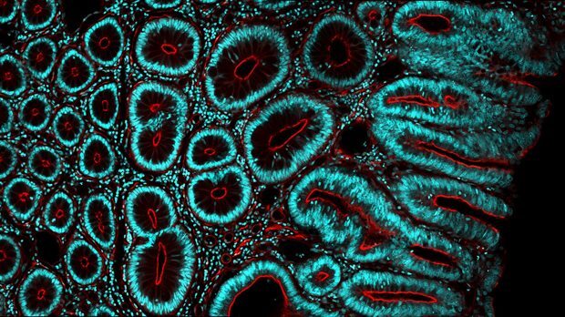 Bowel-cancer-image-1240x400-c